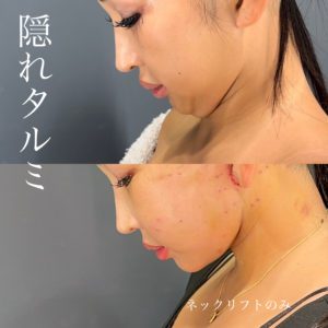 ディープ プレーン フェイスリフト ネックリフト