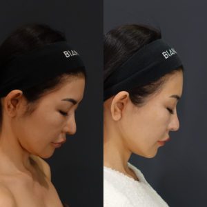 首のたるみに対して、ディーププレーンフェイスリフトを行った症例写真