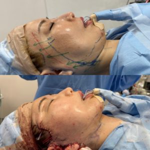 フェイスリフトの再手術は何回までできる？形成外科医が解説