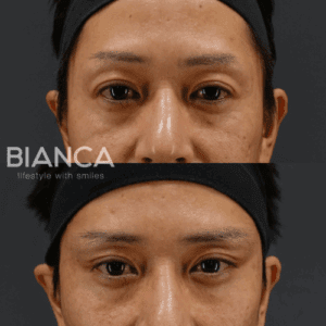 中尾崇医師によるこめかみリフトの症例