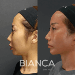 中尾崇医師によるこめかみリフトディーププレーンフェイスリフト症例