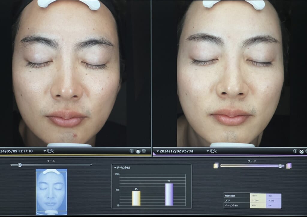 乾燥はお肌の大敵！！神保湿施術とは？