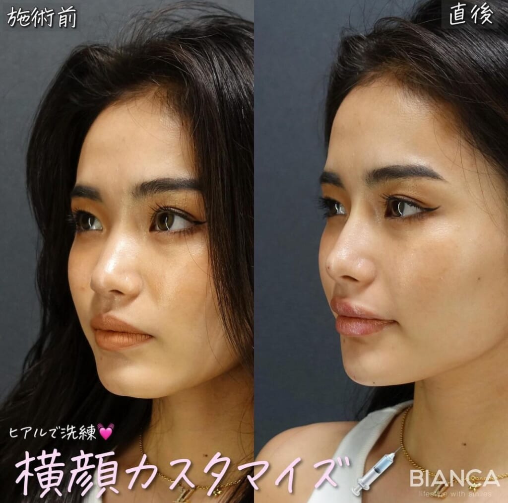 あの人気注入治療で叶える理想のお顔🤩❣️