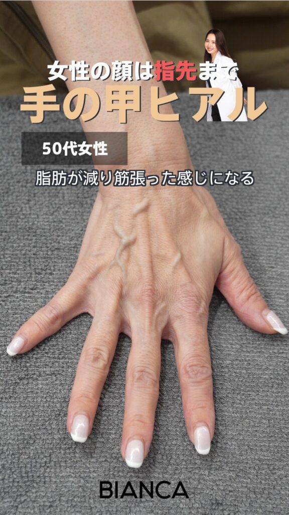 手の甲のシワをヒアルロン酸注入でケア！若々しい自然なハリを目指す方法