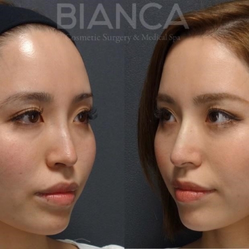 【ダウンタイム】ヒアルロン酸注射後の過ごし方は？顎・唇など部位別に解説