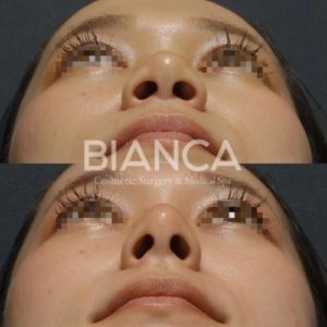 鼻先 鼻筋ヒアルロン酸症例写真-ビアンカクリニック