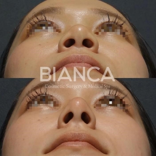 ヒアルロン酸_鼻先_症例写真_ビアンカクリニック