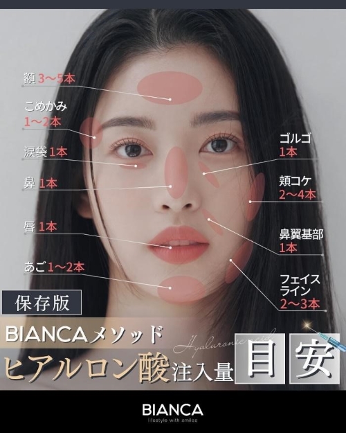 ヒアルロン酸_注入量_目安_マップ