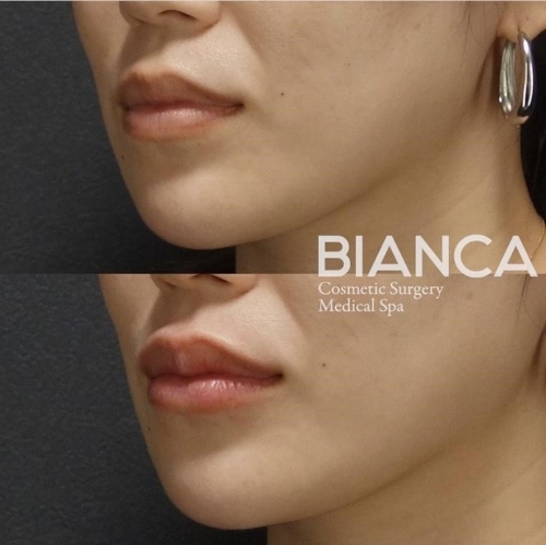 唇ヒアルのダウンタイムはいつまで？痛み・腫れ・注意点を解説