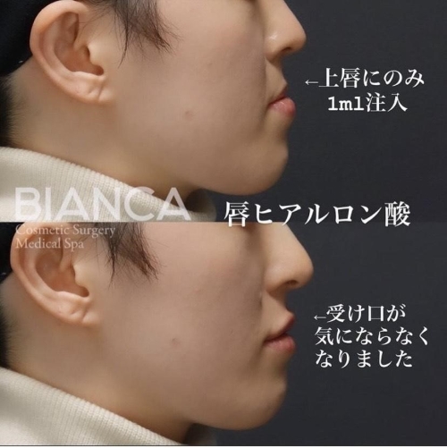 【ヒアルロン酸注入】唇ヒアルで魅力的なリップに！ダウンタイムや考えうる失敗についても解説