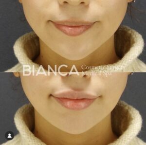 大久保由有医師の唇ヒアルロン酸症例写真-女性正面