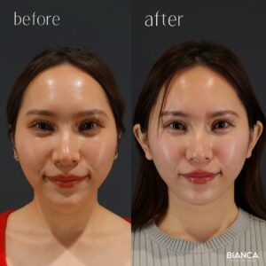 立ち耳ヒアルロン酸注入症例写真