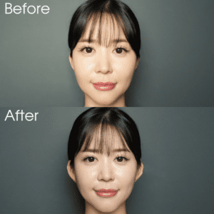 立ち耳ヒアルとは？愛らしい耳元を叶える新トレンド施術を医師が解説