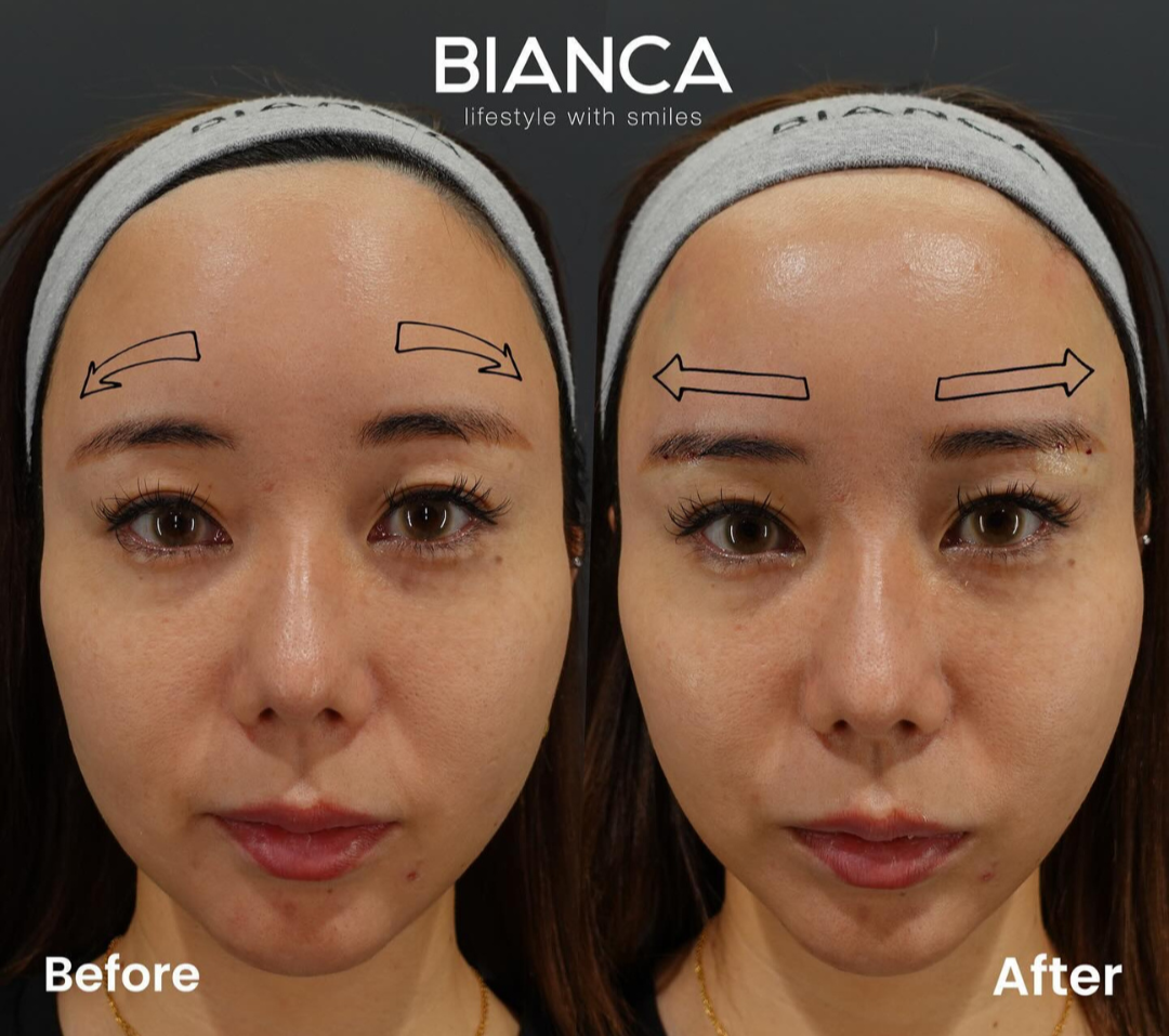 フォックスアイ（目元の糸リフト）　とは