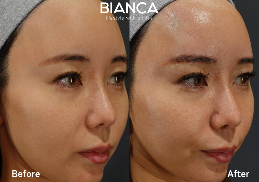 切開なしでこめかみのリフトアップが叶う