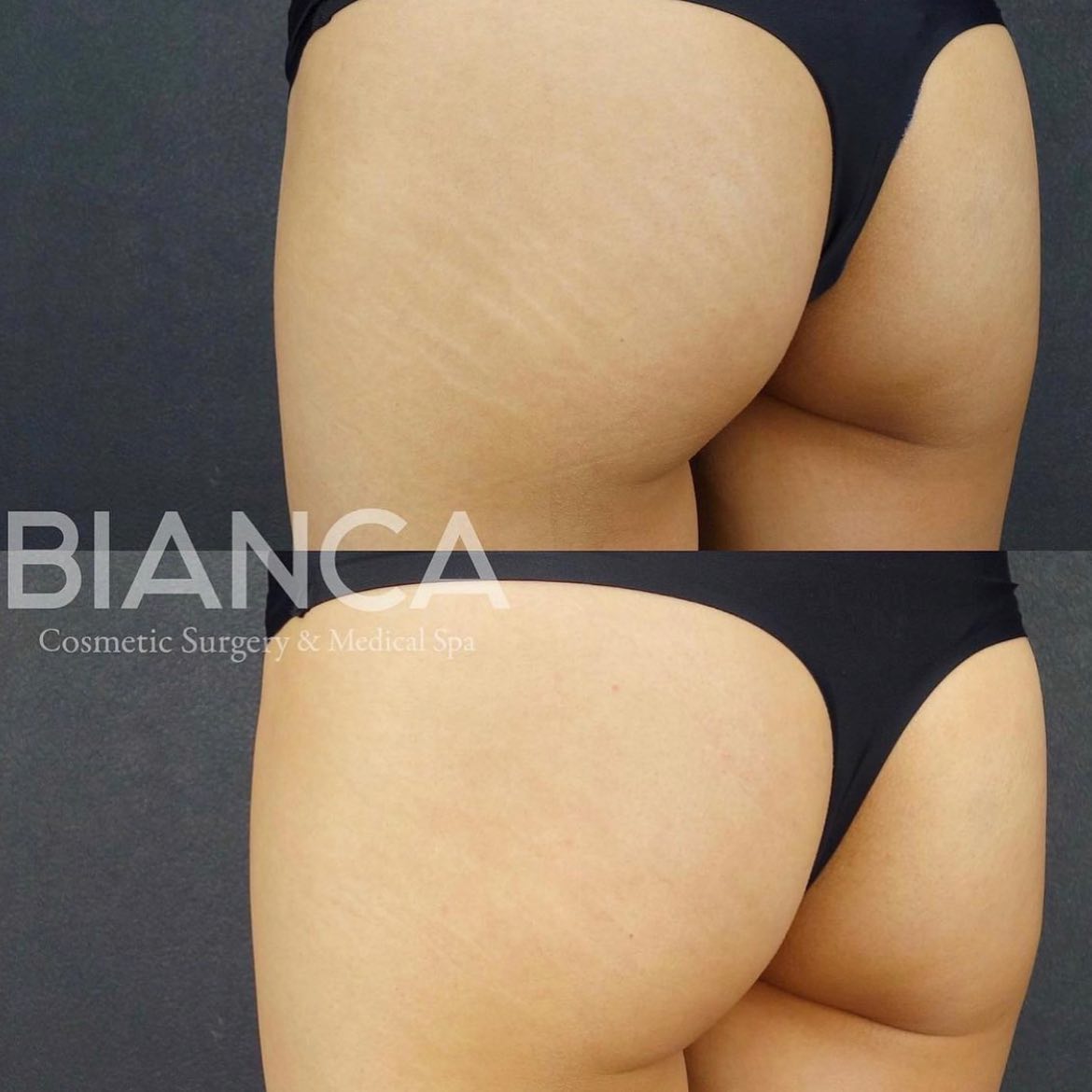 妊娠線・肉割れを改善