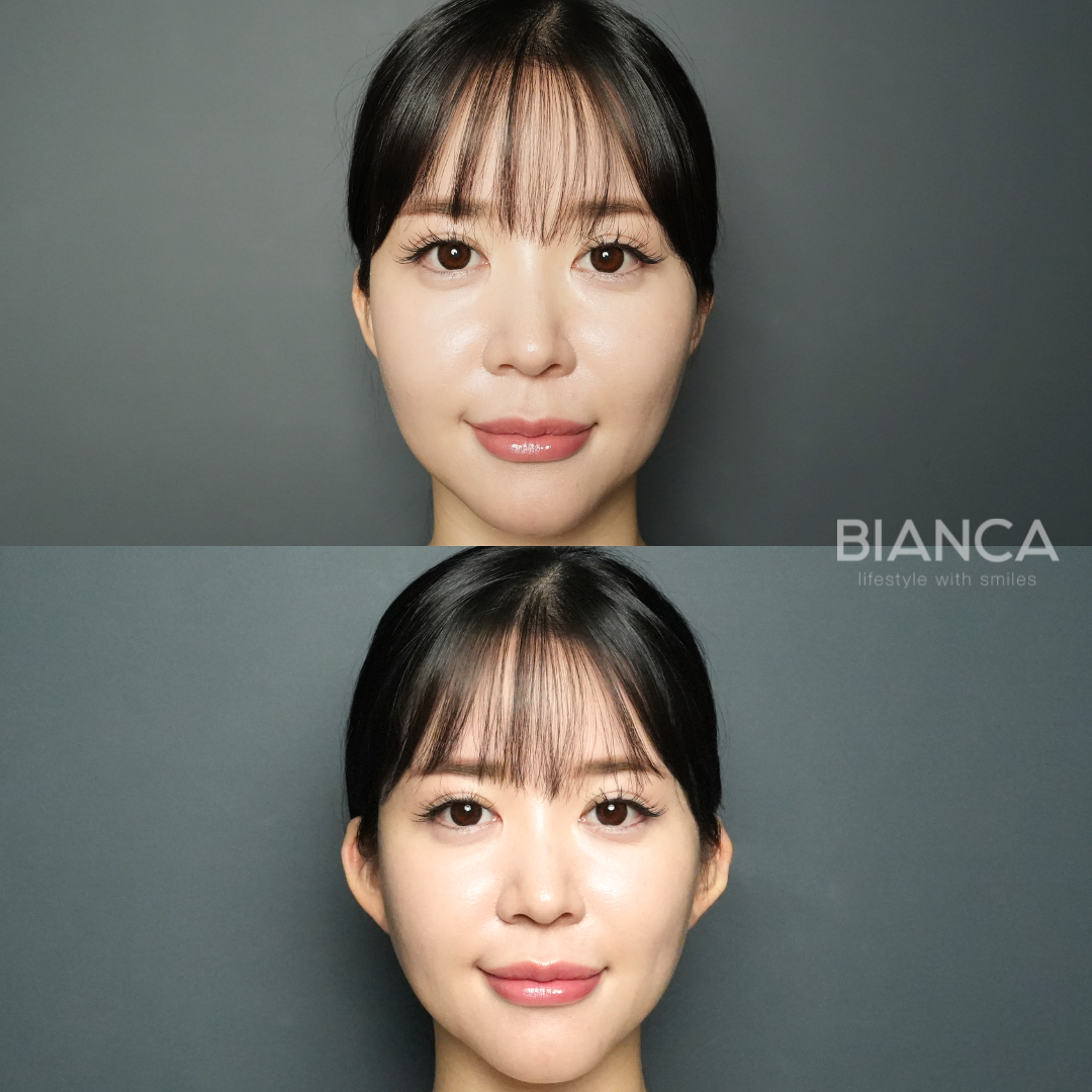 立ち耳ヒアルロン酸