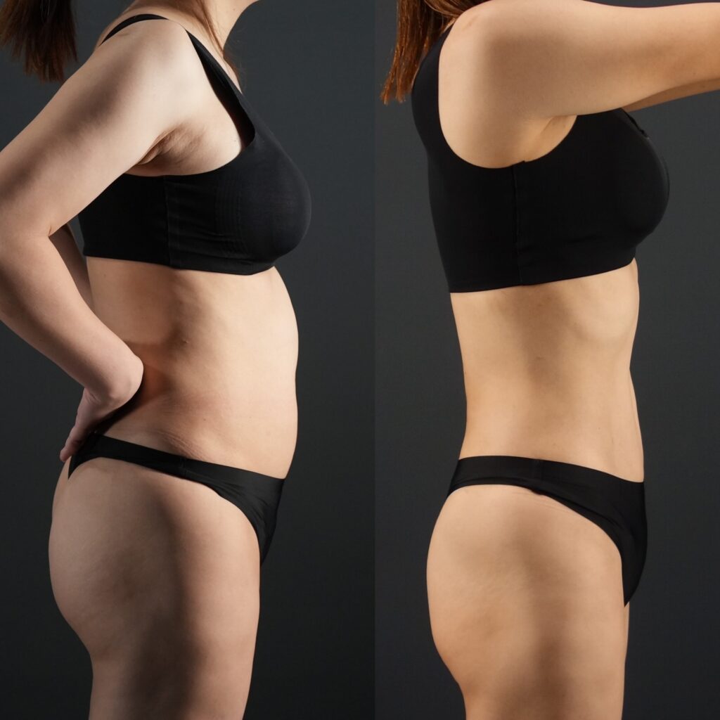 🩵脂肪吸引のダウンタイム｜過ごし方＆リアルな経過の話