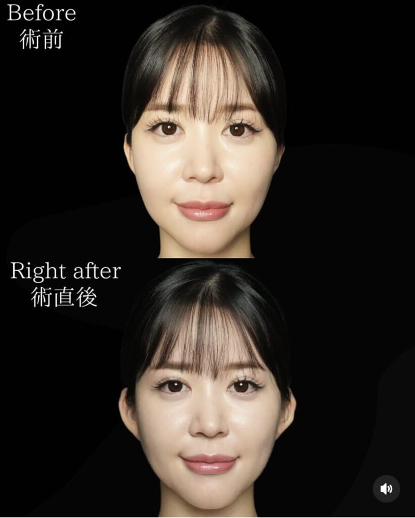 エルフ・フェアリーヒアルロン酸(立ち耳ヒアルロン酸)