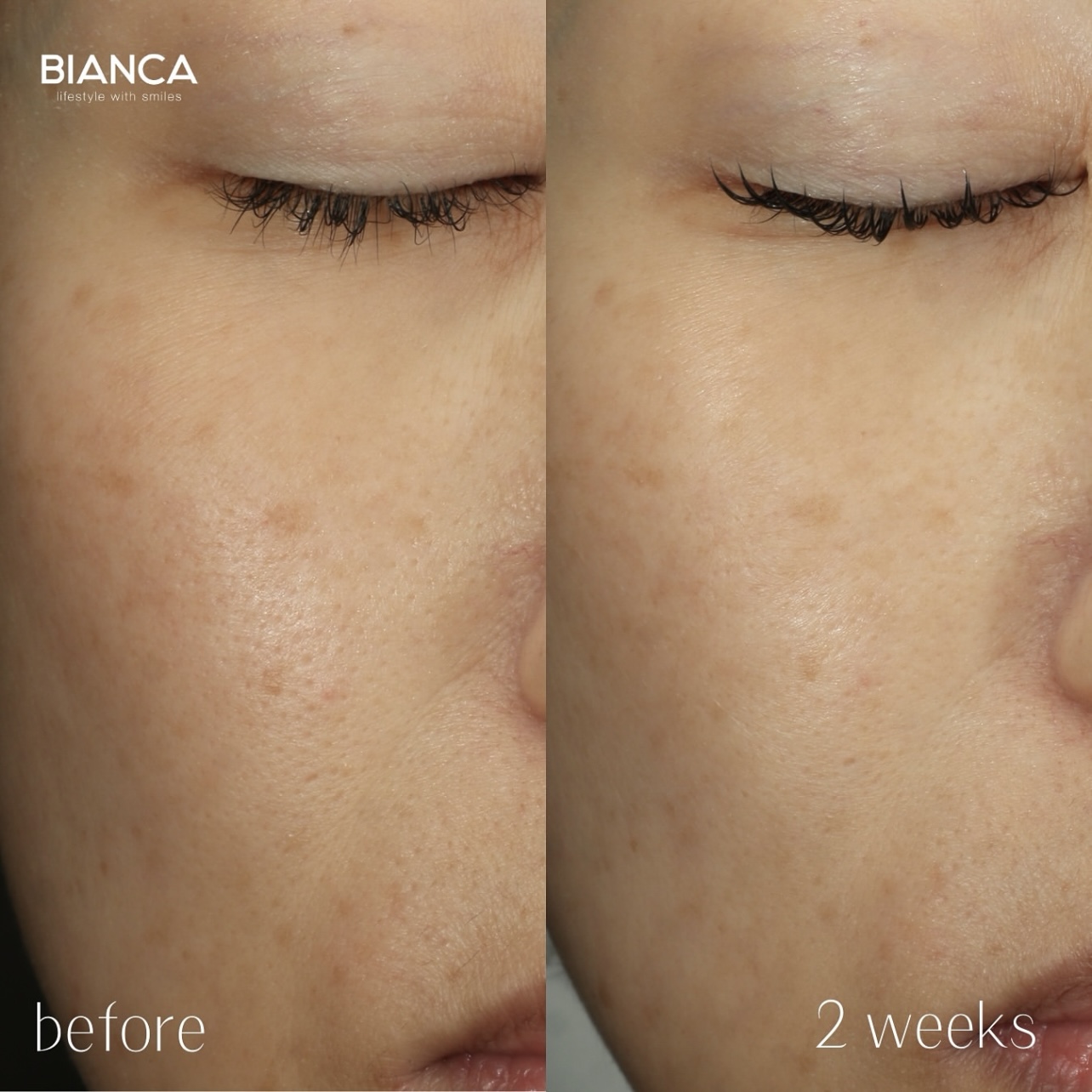 ターゲットクールによるジュベルック注入