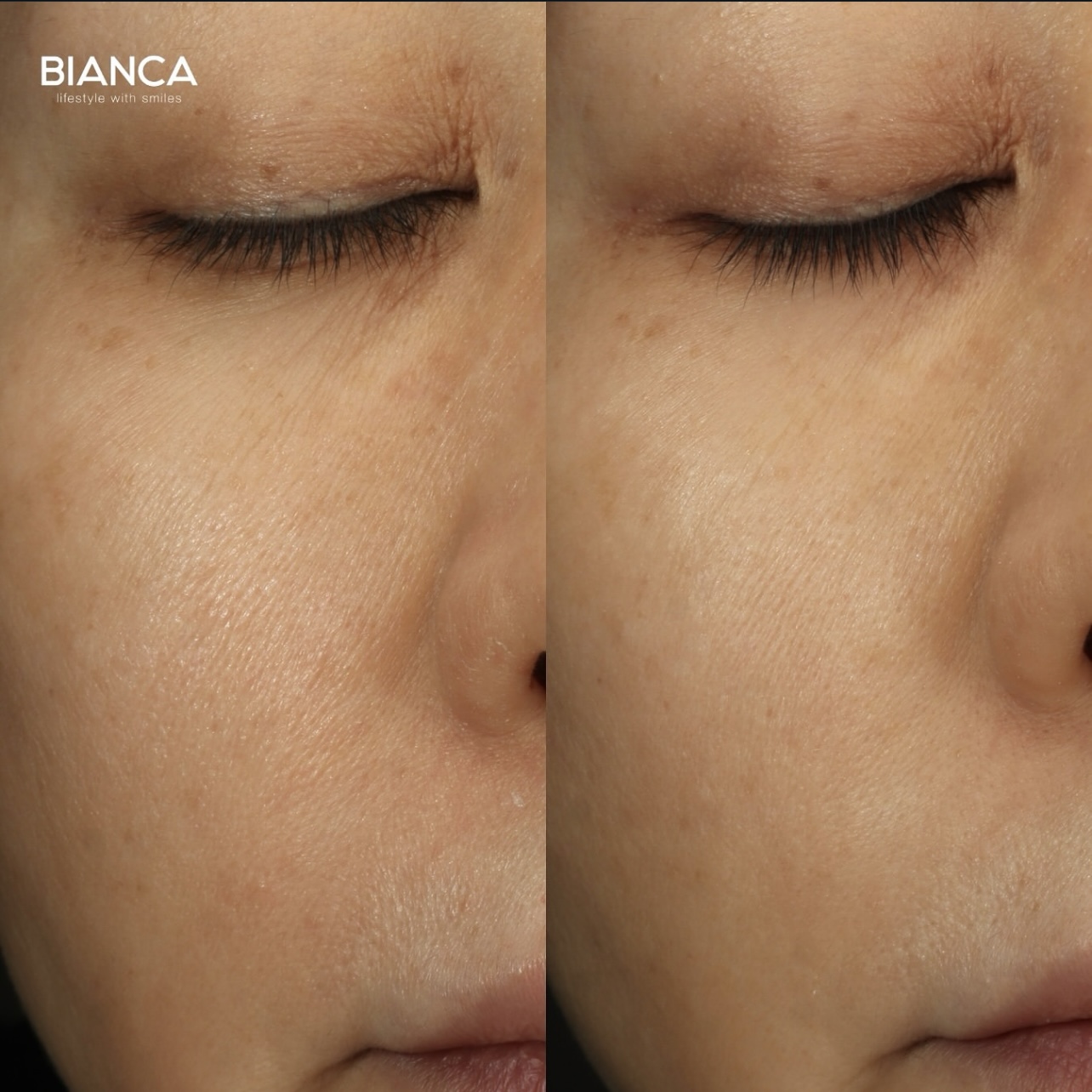 ターゲットクールによるプルリアル注入