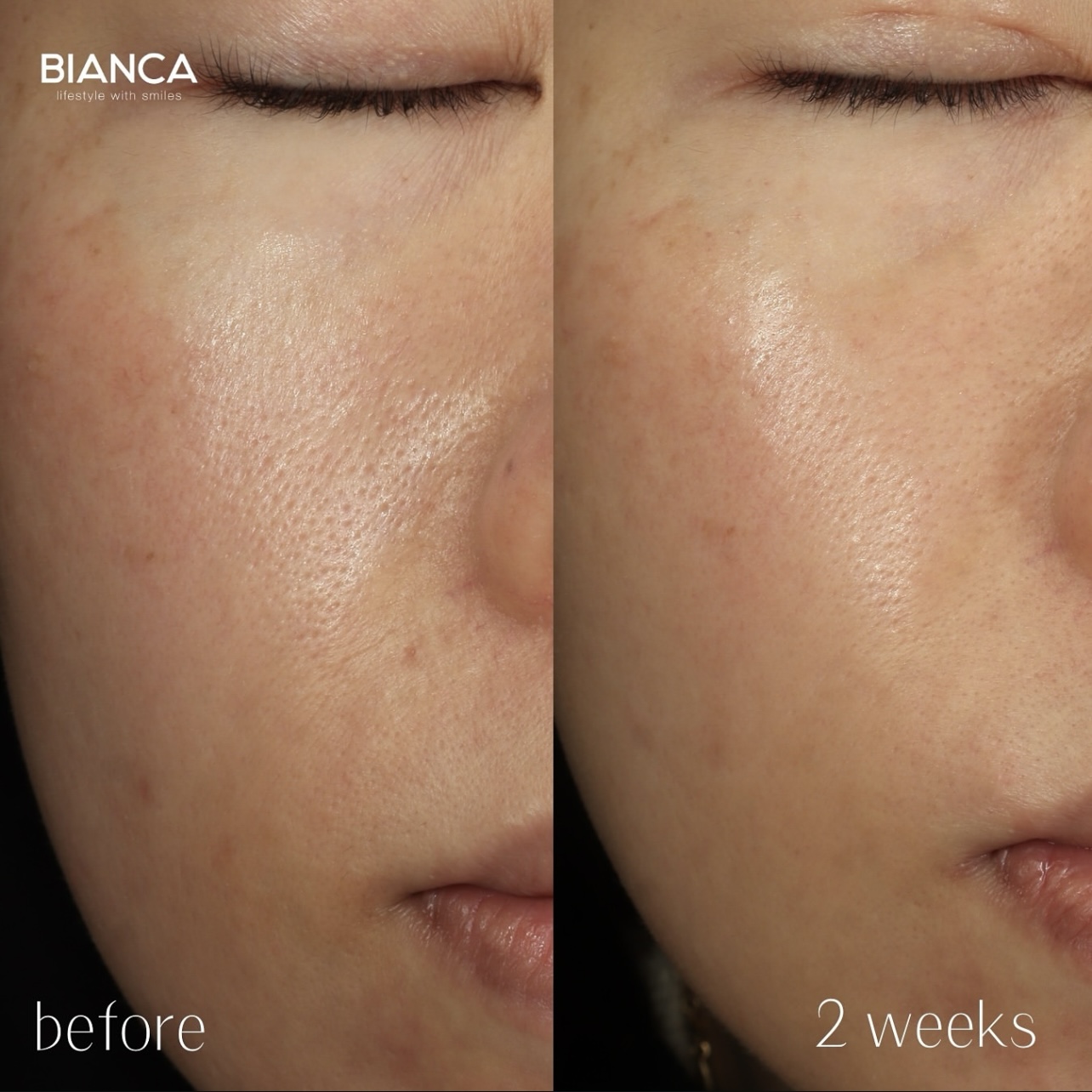 ターゲットクールによるボツリヌストキシン製剤注入