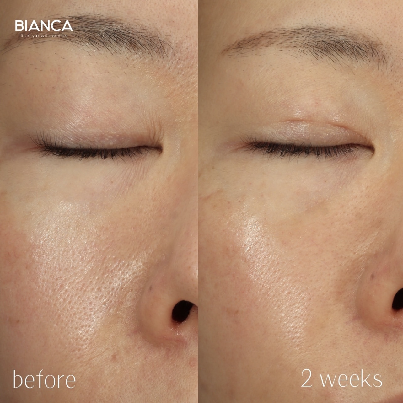 ターゲットクールによるボツリヌストキシン製剤注入