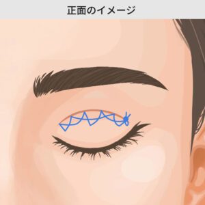 二重埋没法 自然癒着法 銀座・表参道にあるBIANCA CLINIC ビアンカクリニック|美容外科・美容皮膚科・再生医療・美容婦人科・美容内科・医療アートメイク