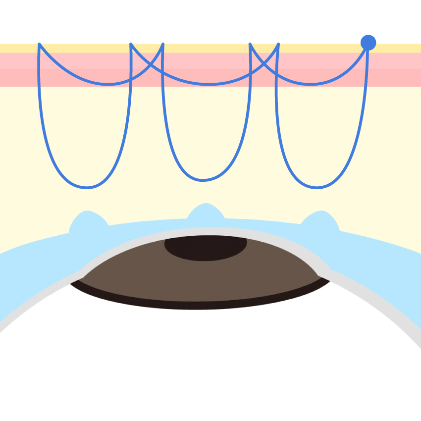 二重埋没法 自然癒着法