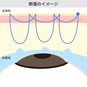 二重埋没法 自然癒着法 銀座・表参道にあるBIANCA CLINIC ビアンカクリニック|美容外科・美容皮膚科・再生医療・美容婦人科・美容内科・医療アートメイク