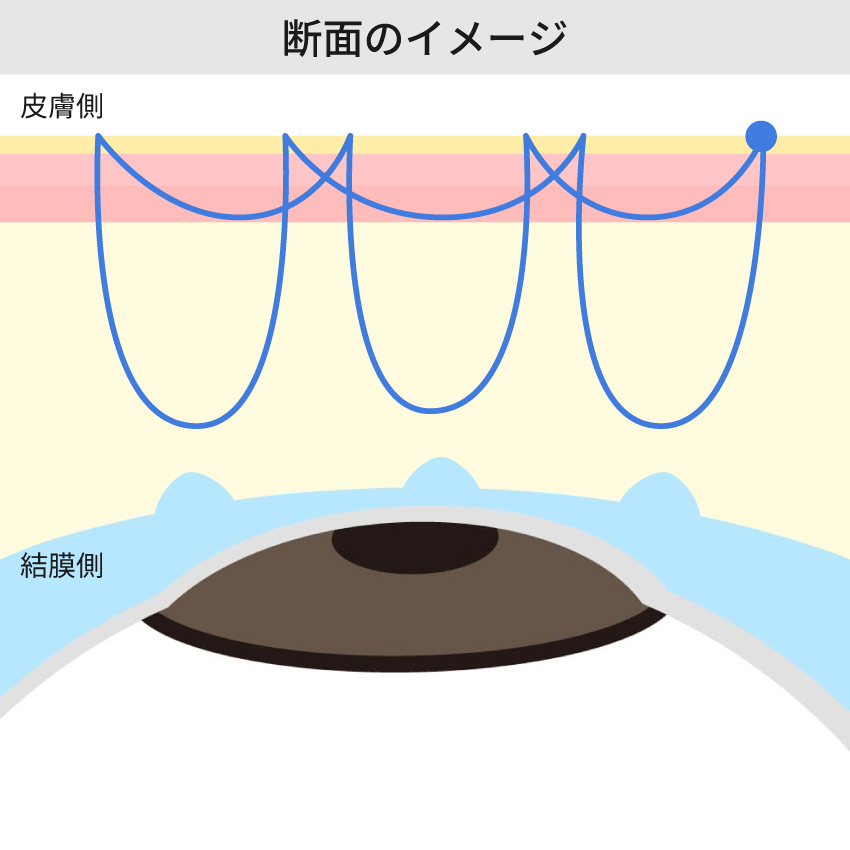 二重埋没法 自然癒着法とは