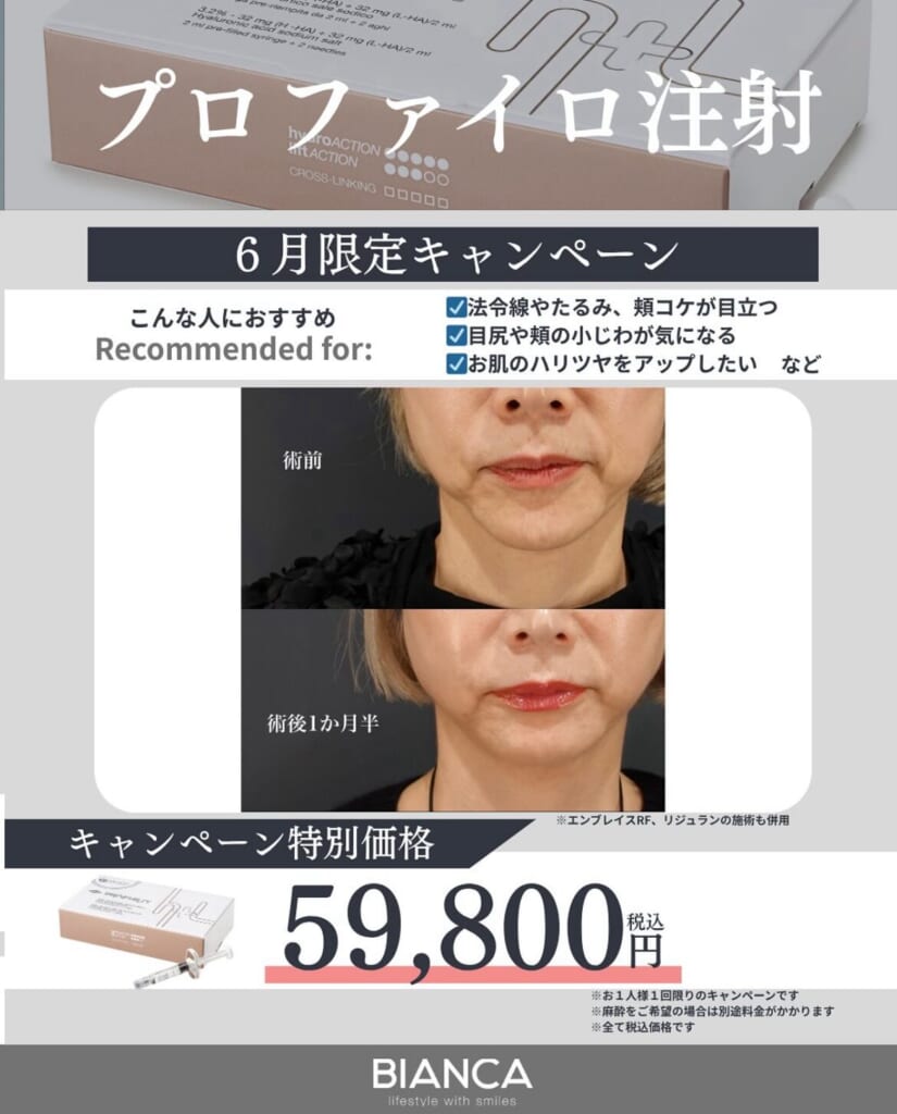 プロファイロ注射のご紹介💉✨