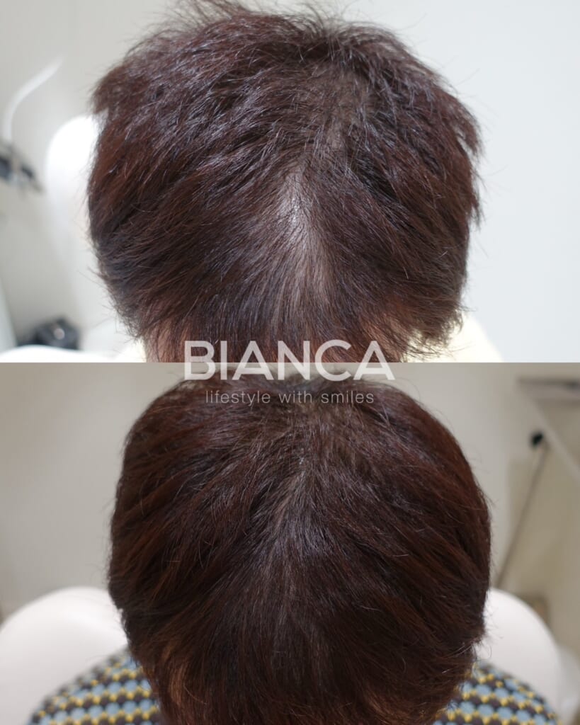 発毛・発育注射(ヘア育)とは