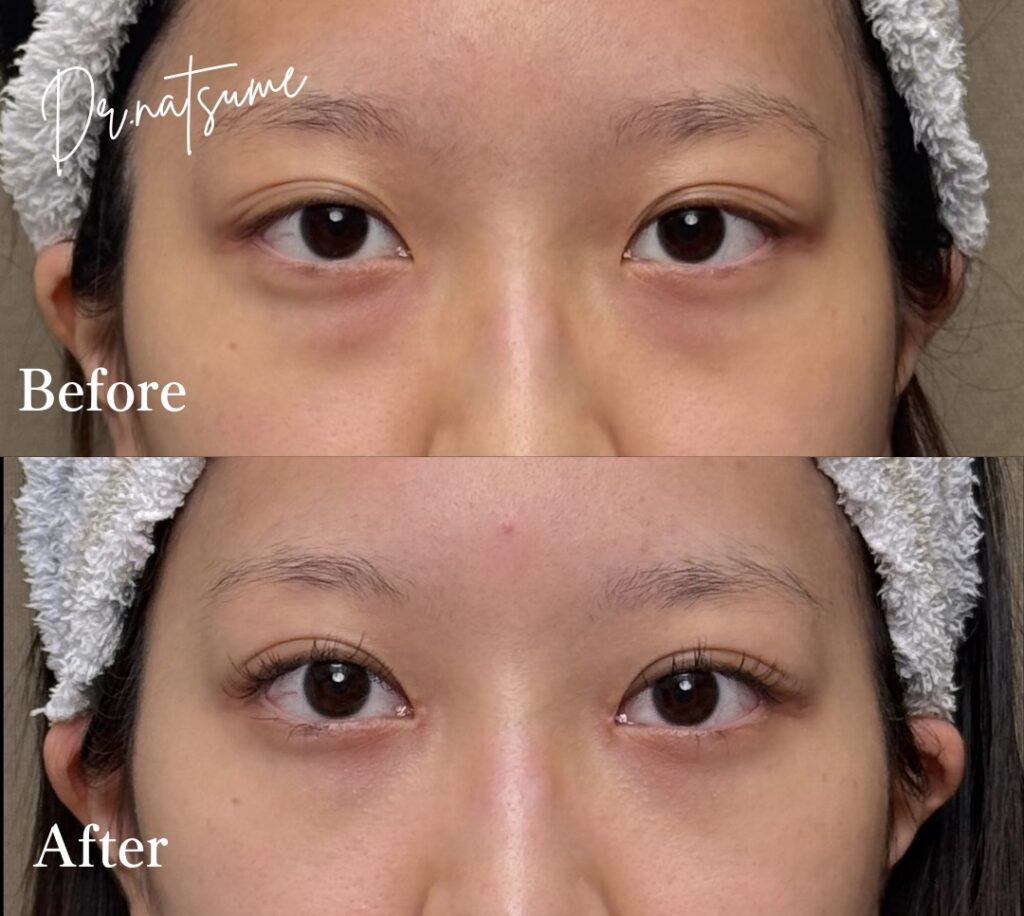 裏ハムラ法とは？美容外科医が解説