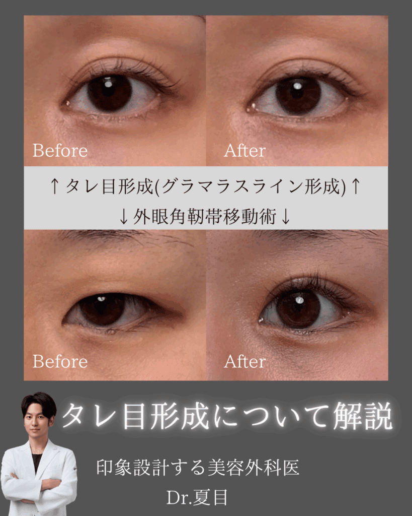 つり目が気になる方必見！タレ目形成or外眼角靭帯移動？