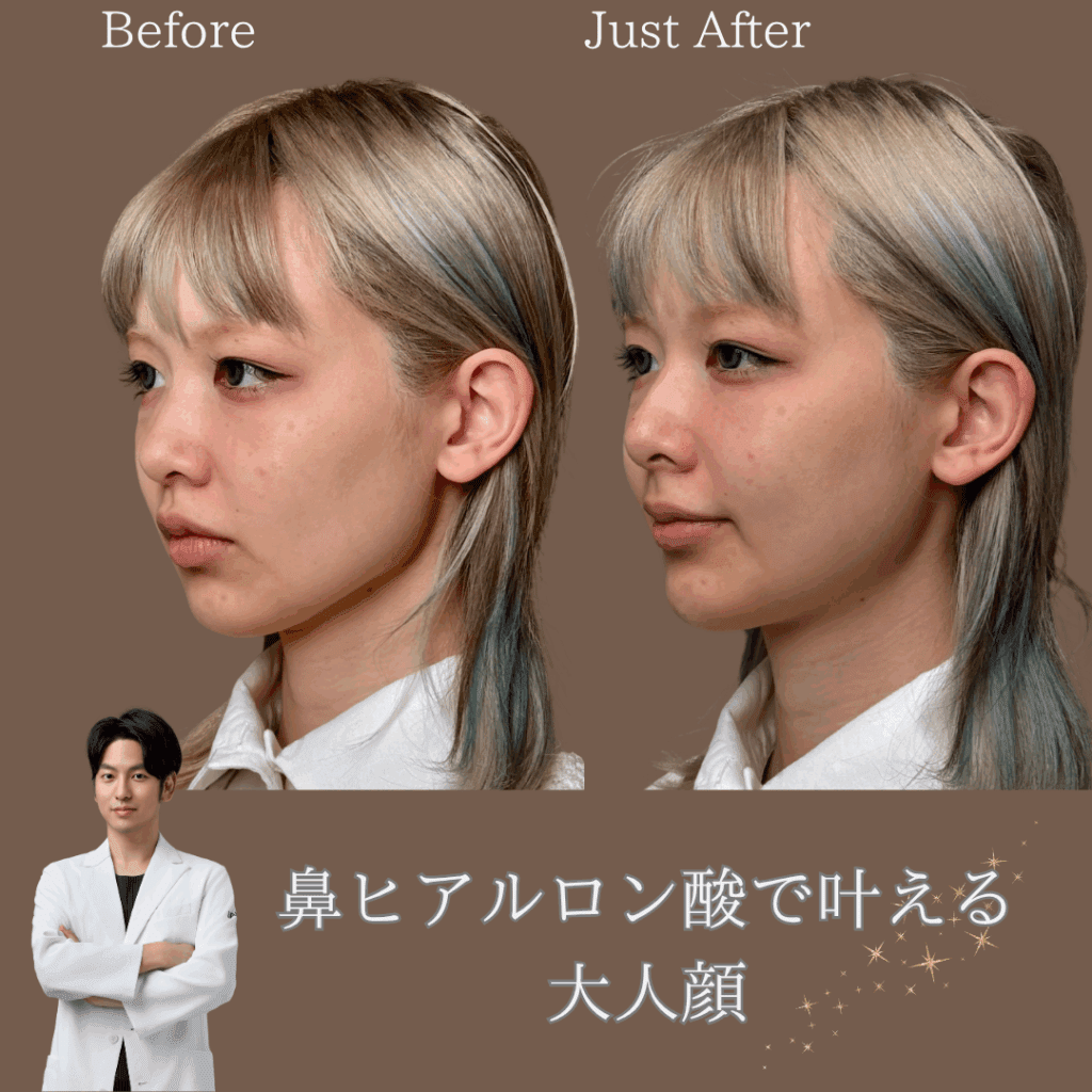 鼻ヒアルロン酸で叶える大人顔