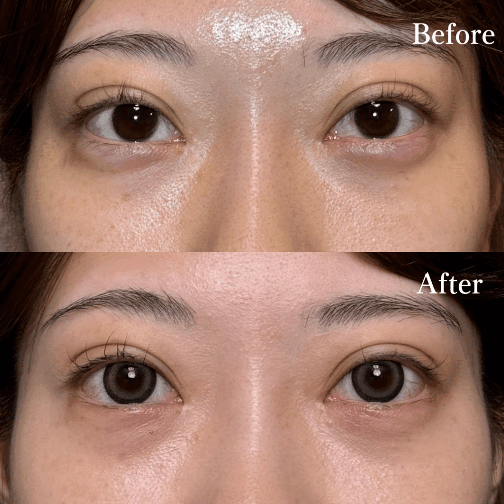 タレ目形成は皮膚切開、結膜切開どっちがいい？