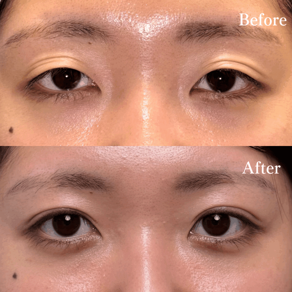 二重埋没と全切開、あなたに合う二重整形はどっち？