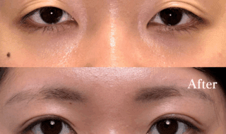 【年齢別】二重が狭くなった？上まぶたのたるみどう治す？｜ビアンカ銀座｜日本を代表する美容健康再生医療のクリニック