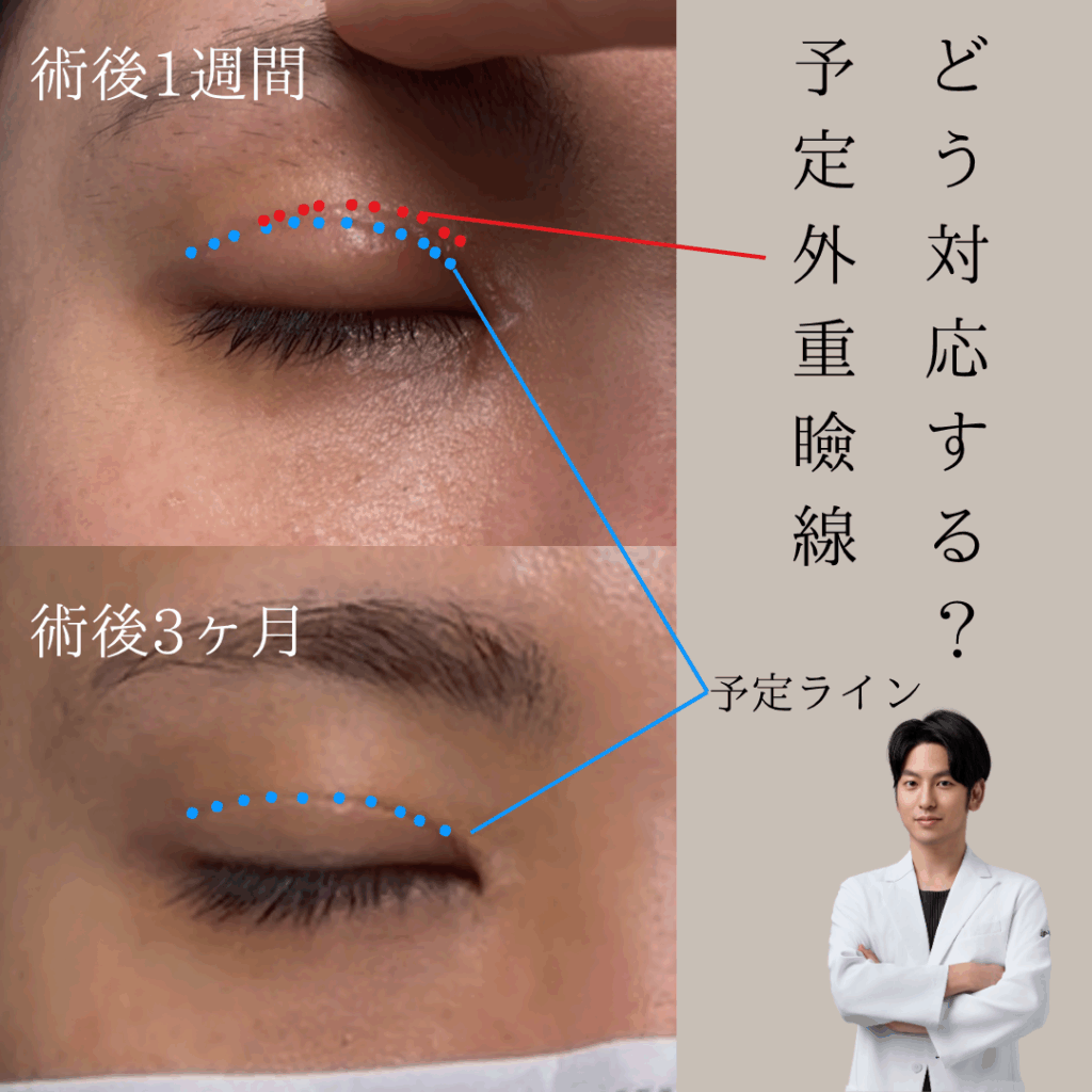 全切開術後合併症、予定外重瞼線とは？