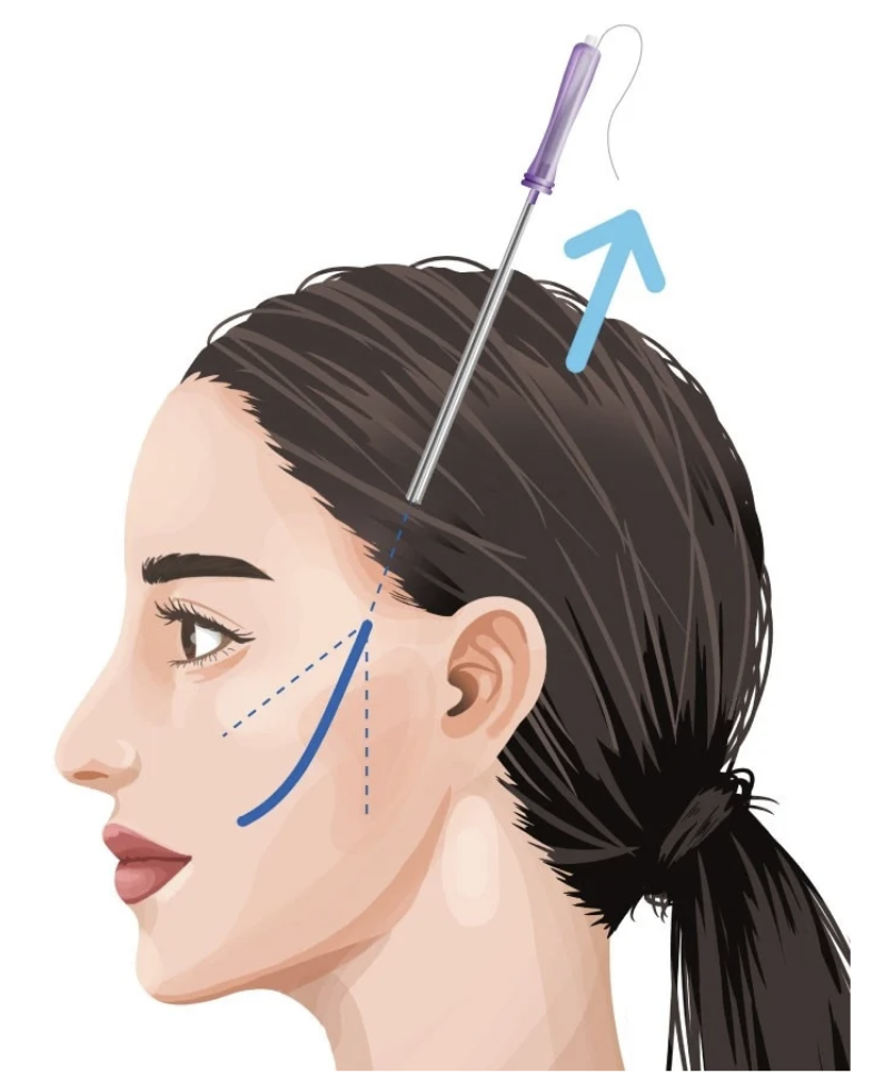 糸リフトは痛い？ダウンタイムは？よくある心配な質問にお答え！