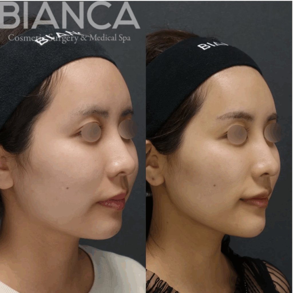 糸リフトは金ドブ？糸リフトの効果を解説！