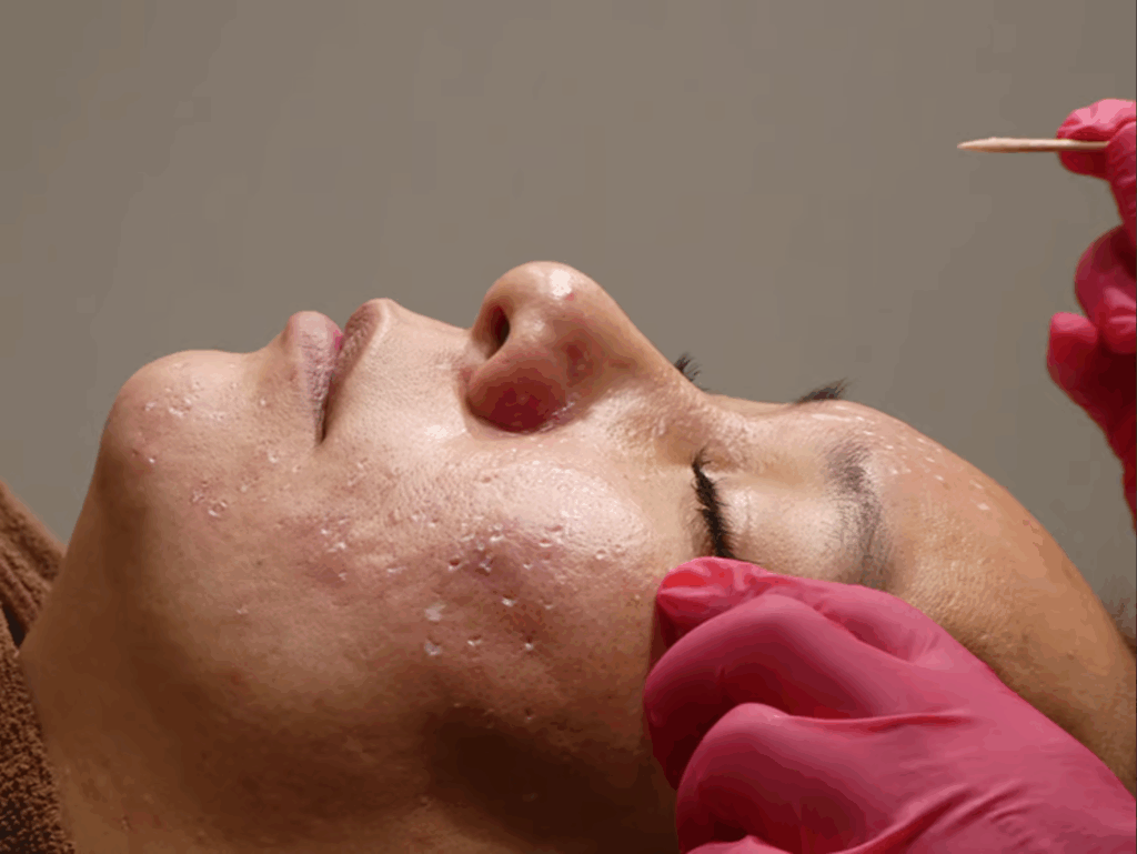 ニキビ跡の瘢痕治療、外側からのアプローチ。