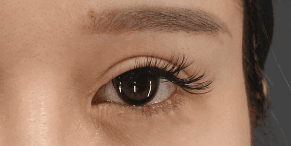 ハム目の相談が急増中！ハム目の原因と修正方法を美容外科医が解説②