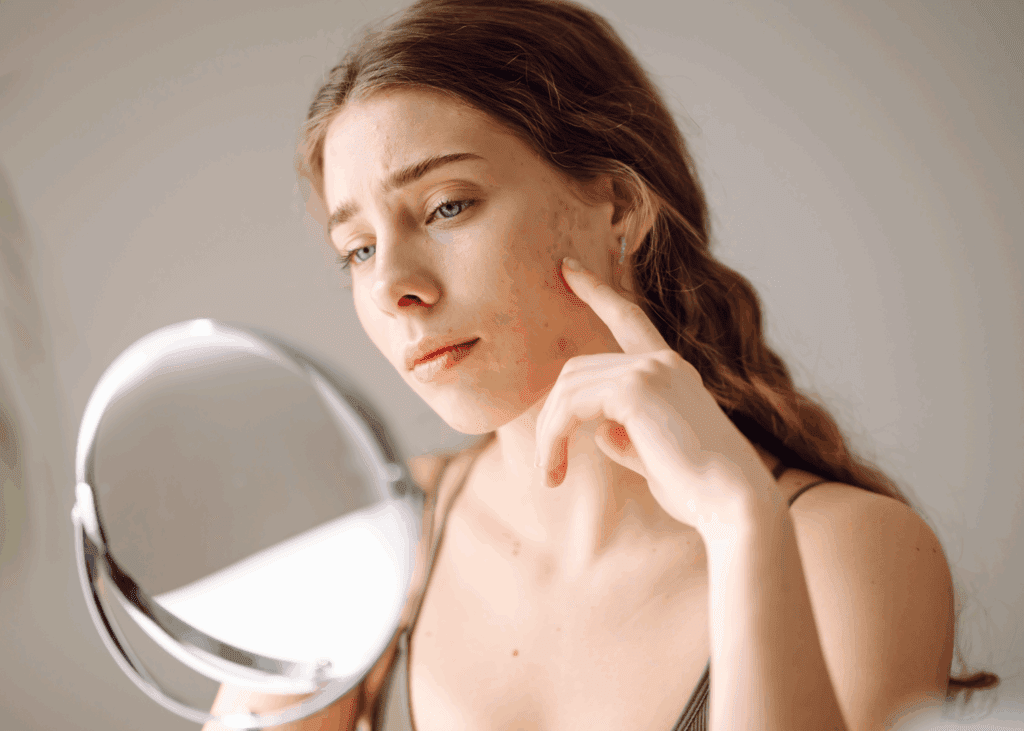 ニキビ跡にも種類あり！赤み、クレーター瘢痕で治療が違います。