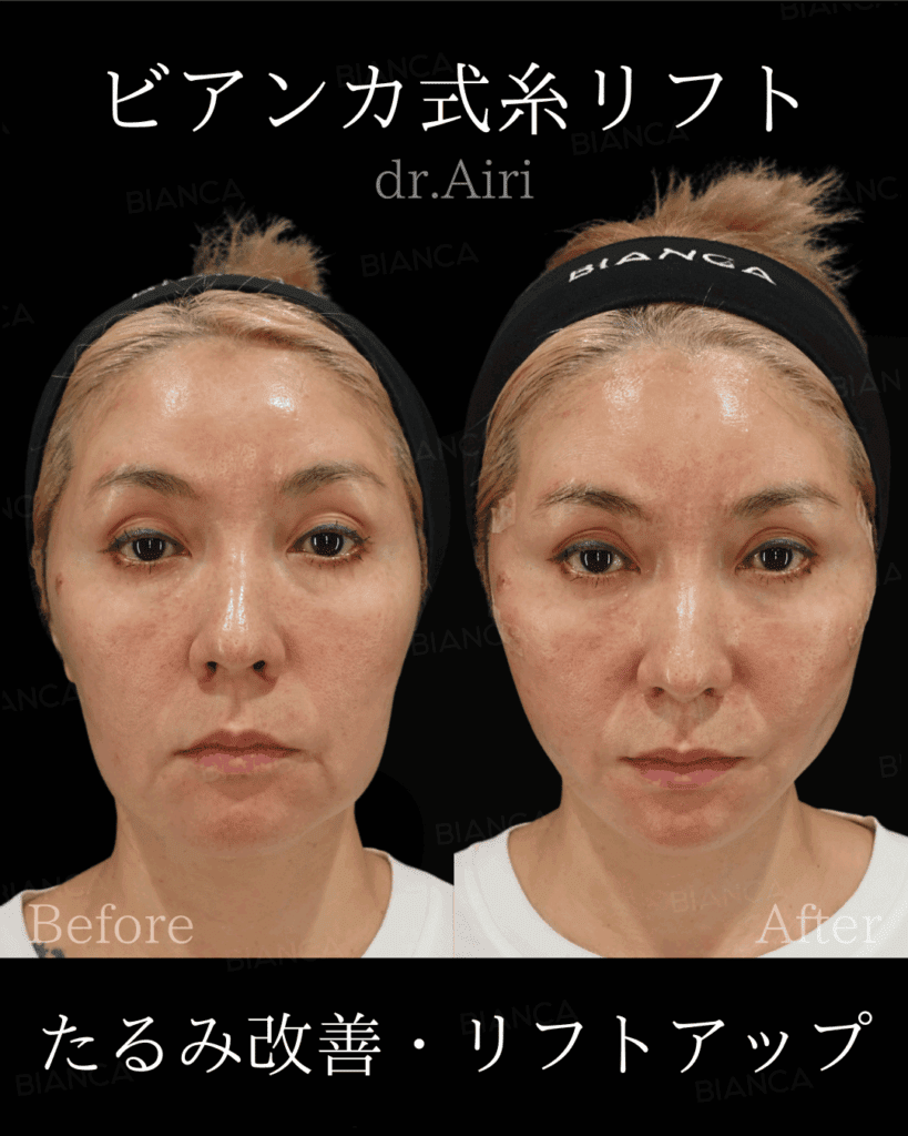 糸リフトでたるみ改善！効果や持続期間・ダウンタイムを徹底解説