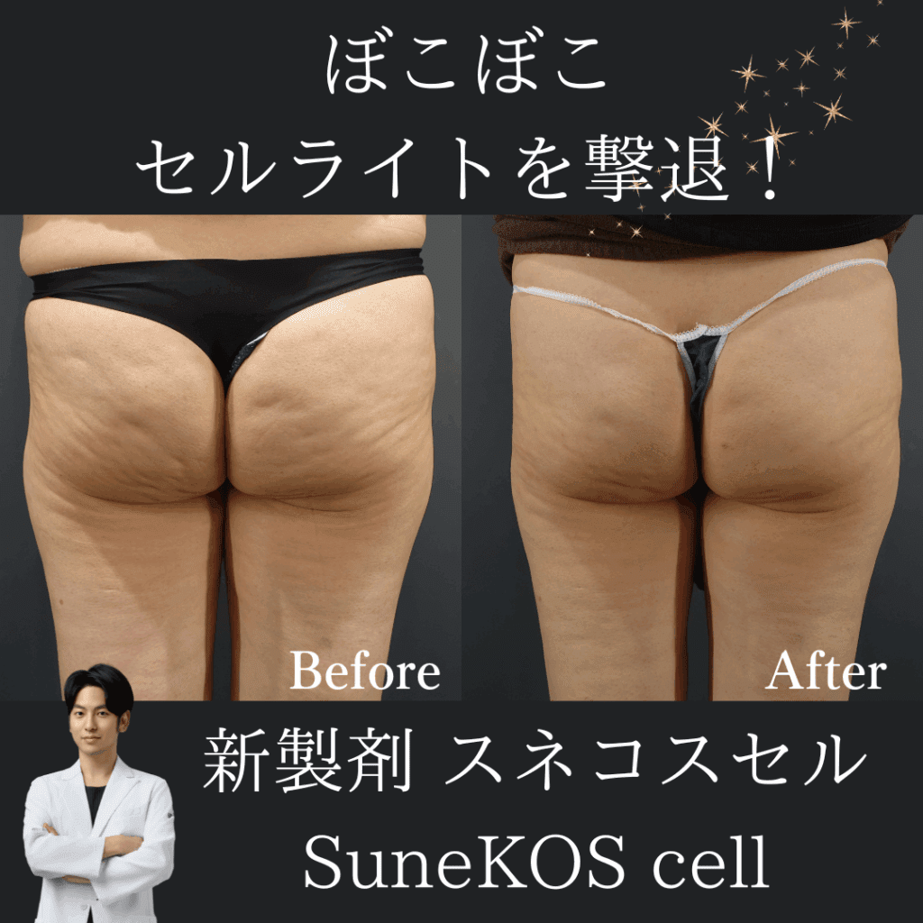 セルライトの最新治療！スネコスセルとは？