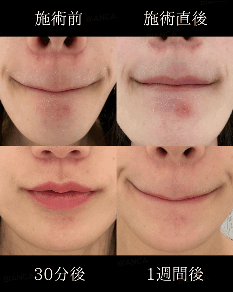 ADVATx(アドバテックス)レーザーとは？写真付きでダウンタイムも解説します