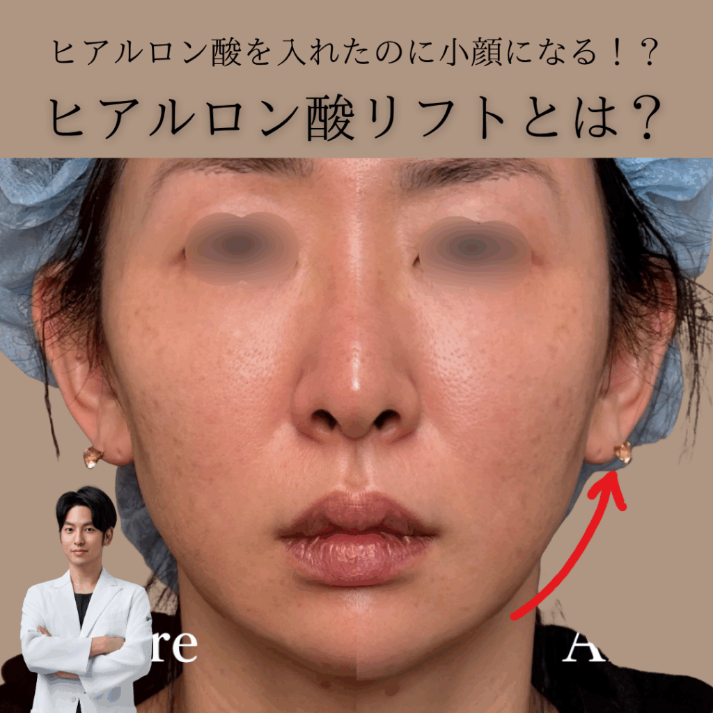 ヒアルロン酸を入れたのに小顔になる！？ヒアルロン酸リフトとは？
