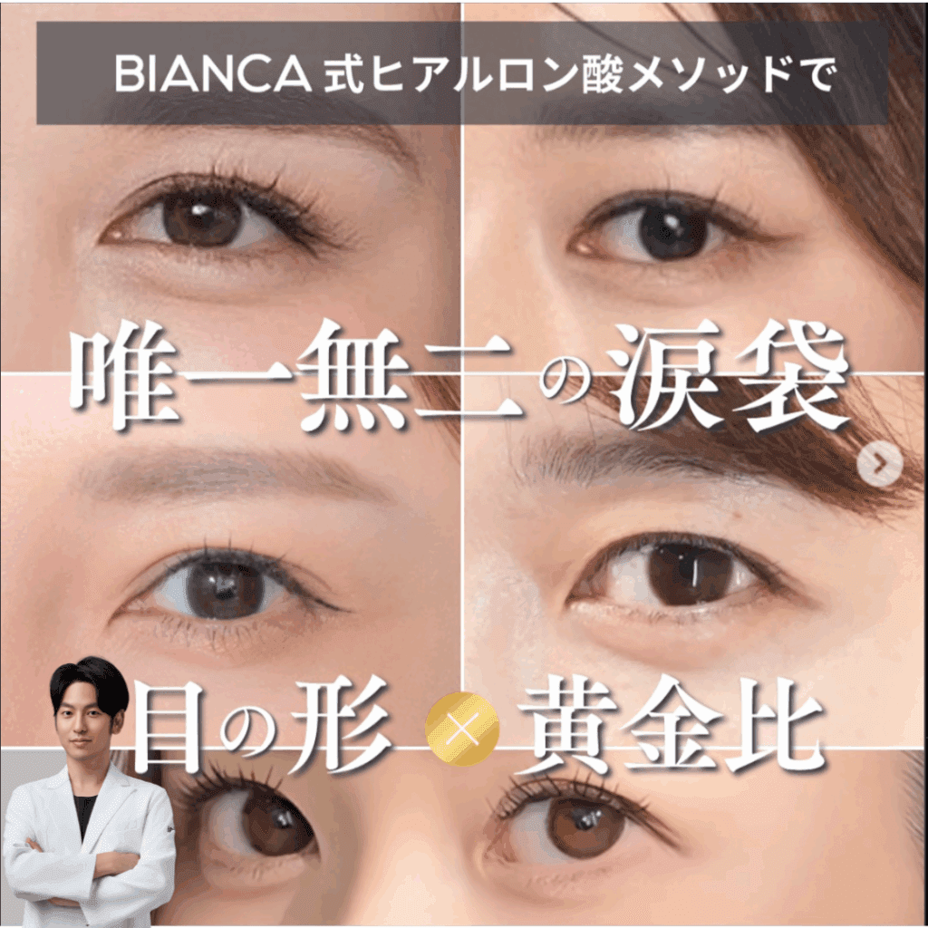 涙袋ヒアルロン酸で垢抜け！